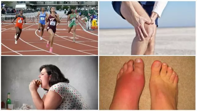 У спортсменов и танцоров, при физической работе нагрузка на ноги больше, а значит, костные сочленения изнашиваются быстрее
