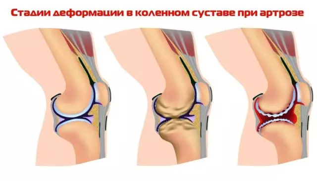 При артрозе коленного сустава 2 степени симптомы выражены более ярко