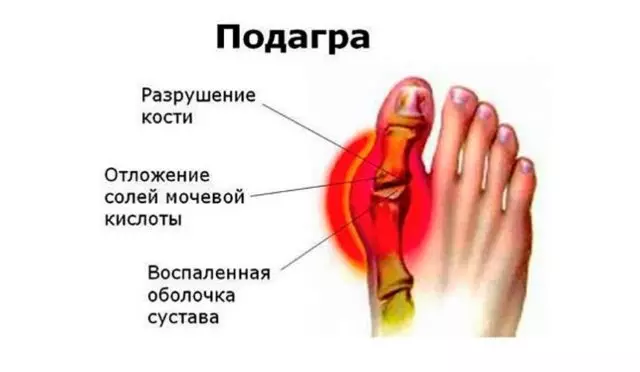 Лечение подагры большого пальца ноги